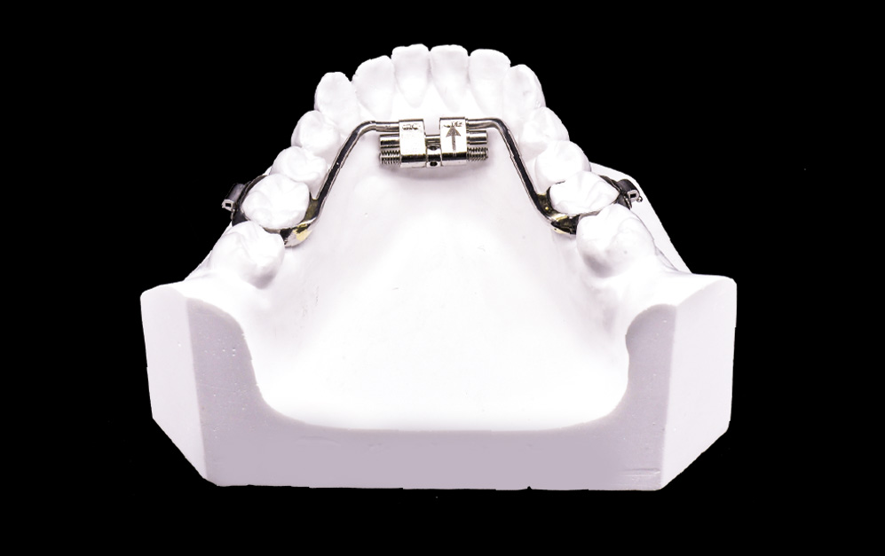 下颌快速螺旋扩弓器（支架式）