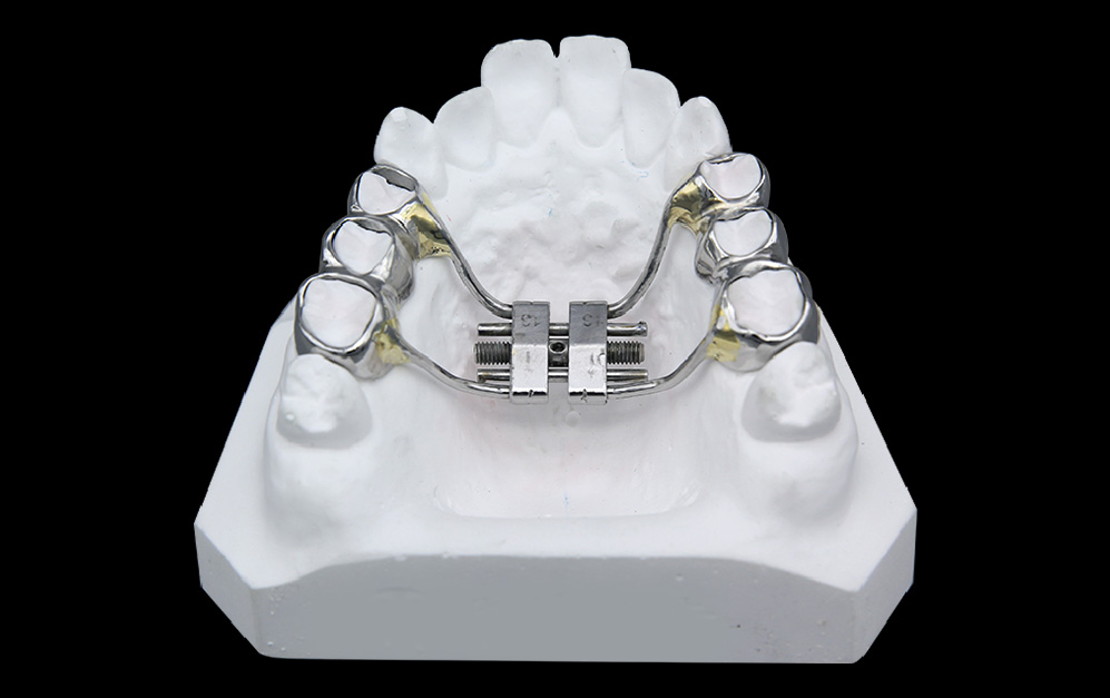 上颌快速螺旋扩弓器（支架式）（RPE）