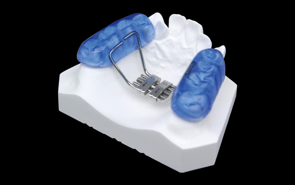 包胶式支架扩弓器（RPE）