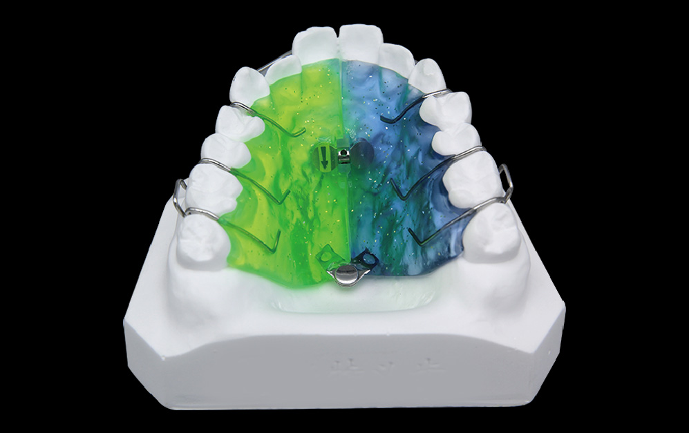 扇形螺旋扩弓器