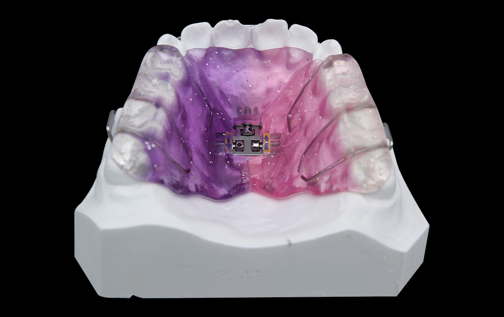 三维螺旋扩弓器（基托式）