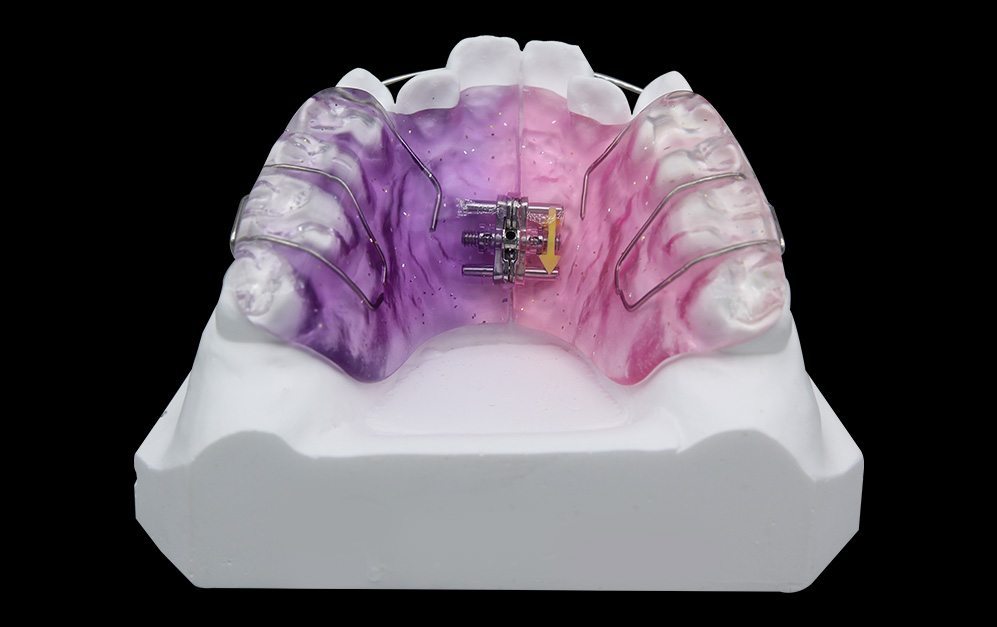 双向螺旋扩弓器
