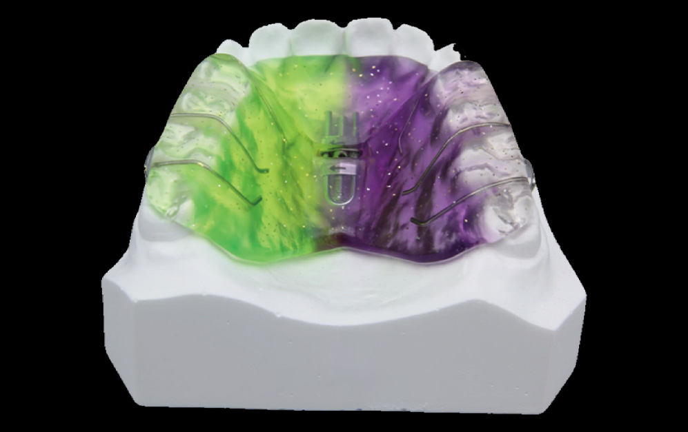 单向螺旋扩弓器