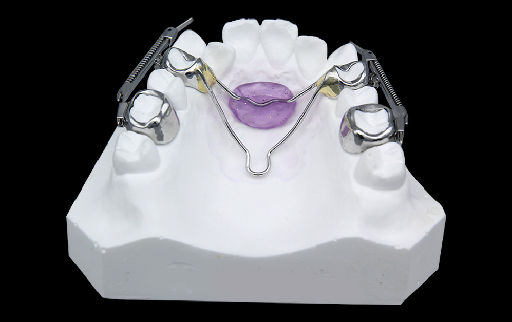 磨牙推进器（颊舌侧）