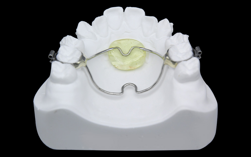 兰丝腭弓+横腭杆（联合支抗）