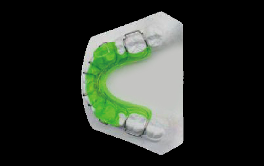 SGTB功能性矫治器