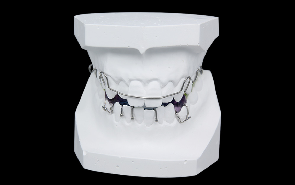 双导板功能矫治器（twin block / TB）