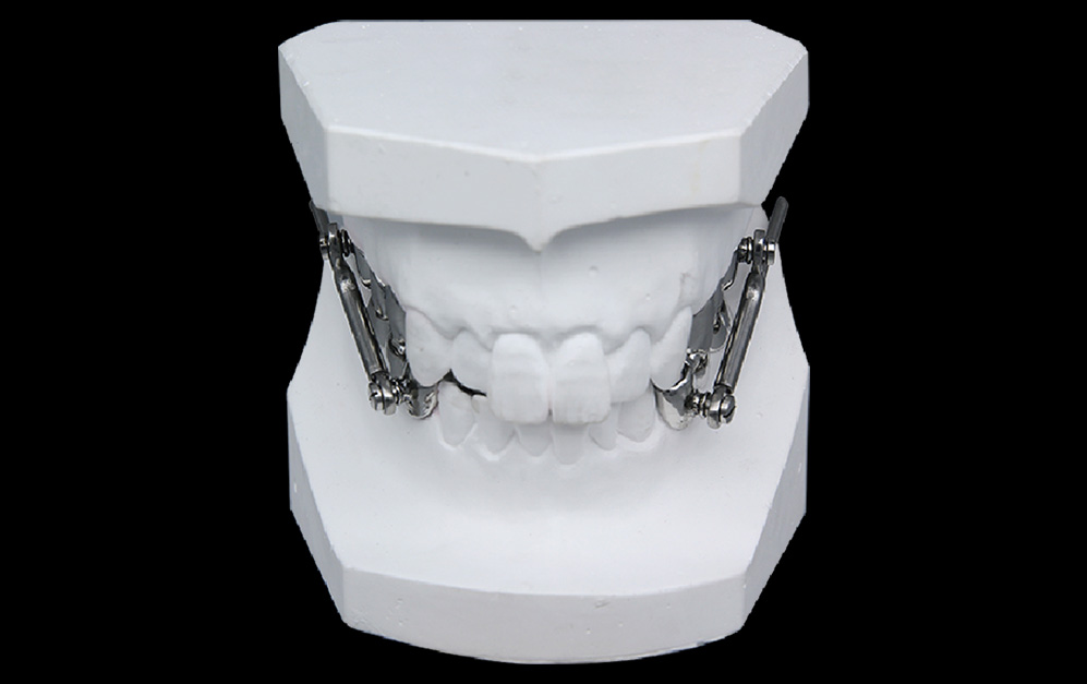 咬合前移器矫治器（Herbst）