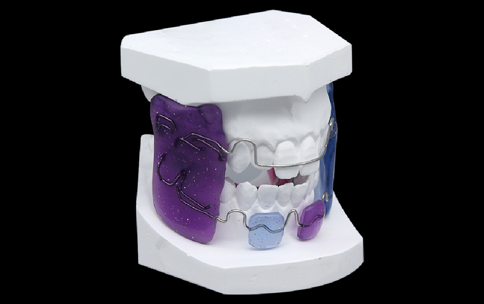 法兰克Ⅱ功能矫治器（FR2）