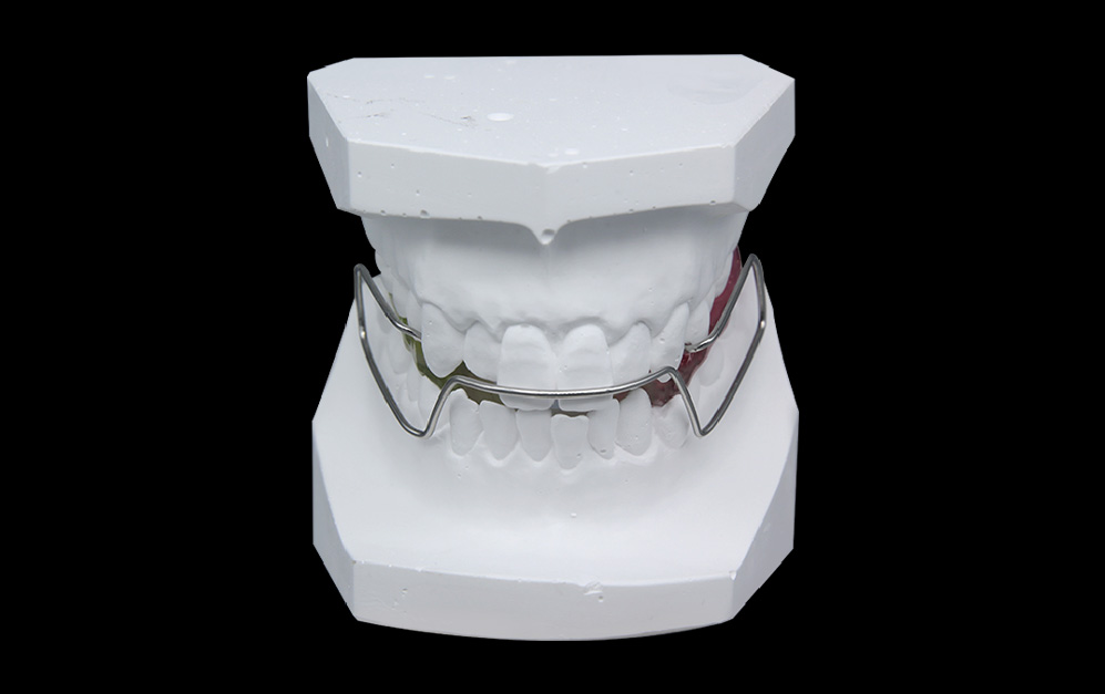 比纳特矫治器/生物调节器（Bionator）