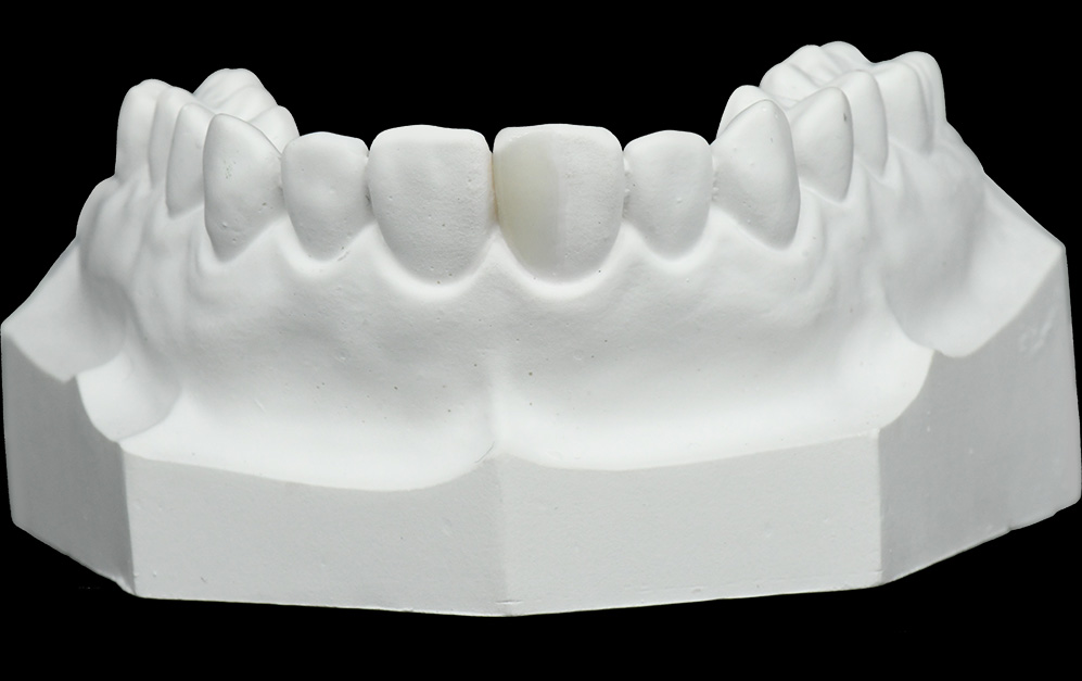 CAD/CAM氧化锆贴面