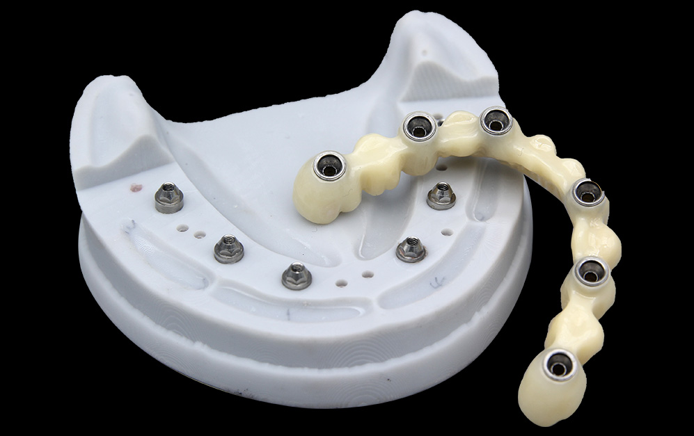 base基台+上部半口氧化锆修复冠