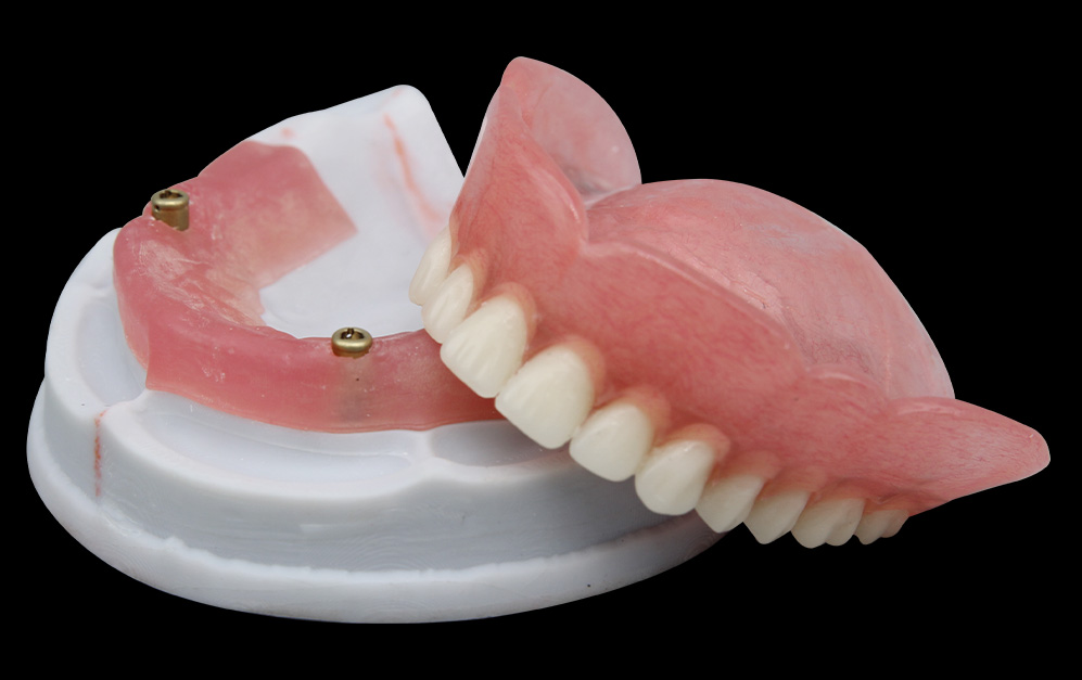 locator+覆盖义齿