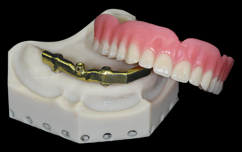 杆卡locator+覆盖义齿