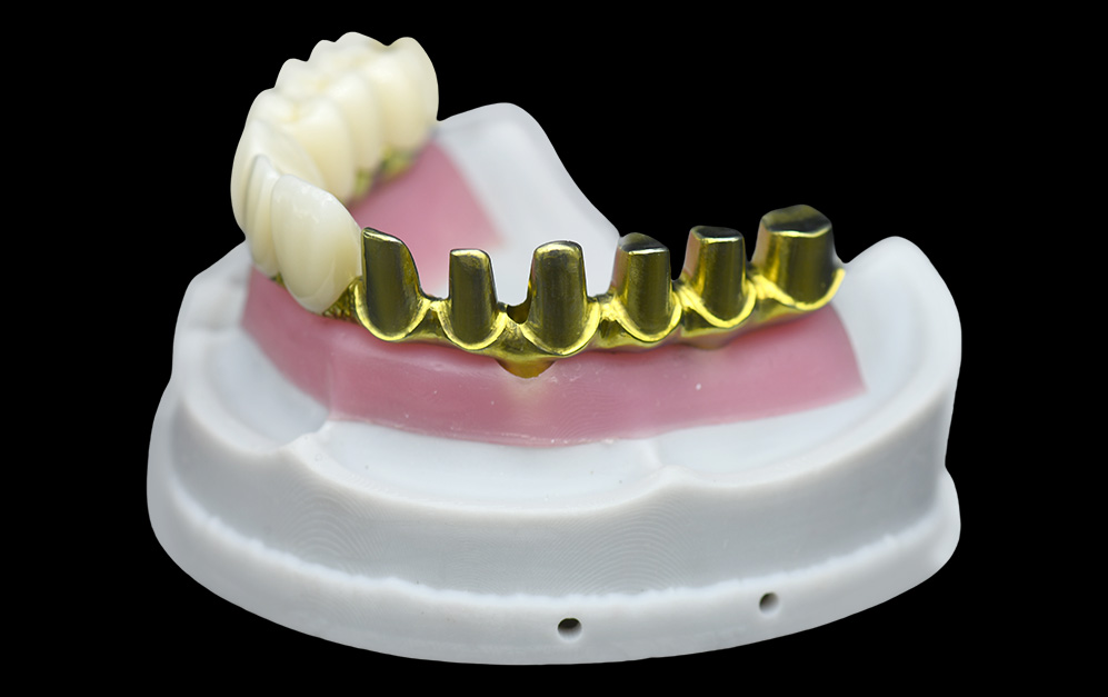 马龙桥+上部半口氧化锆修复冠