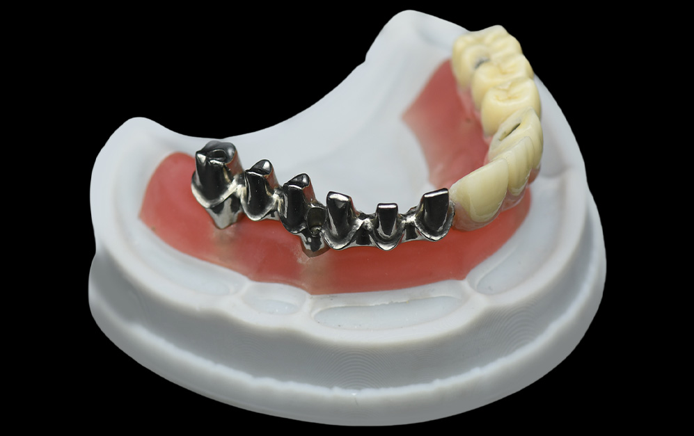 马龙桥+上部半口氧化锆修复冠