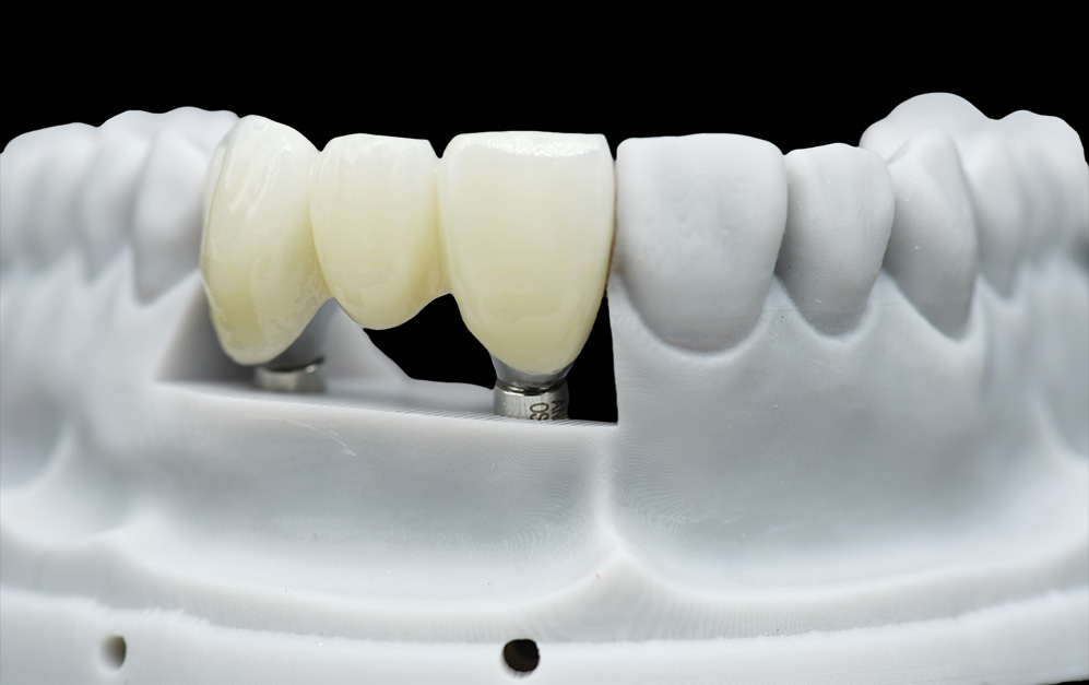 种植基台+氧化锆上部修复