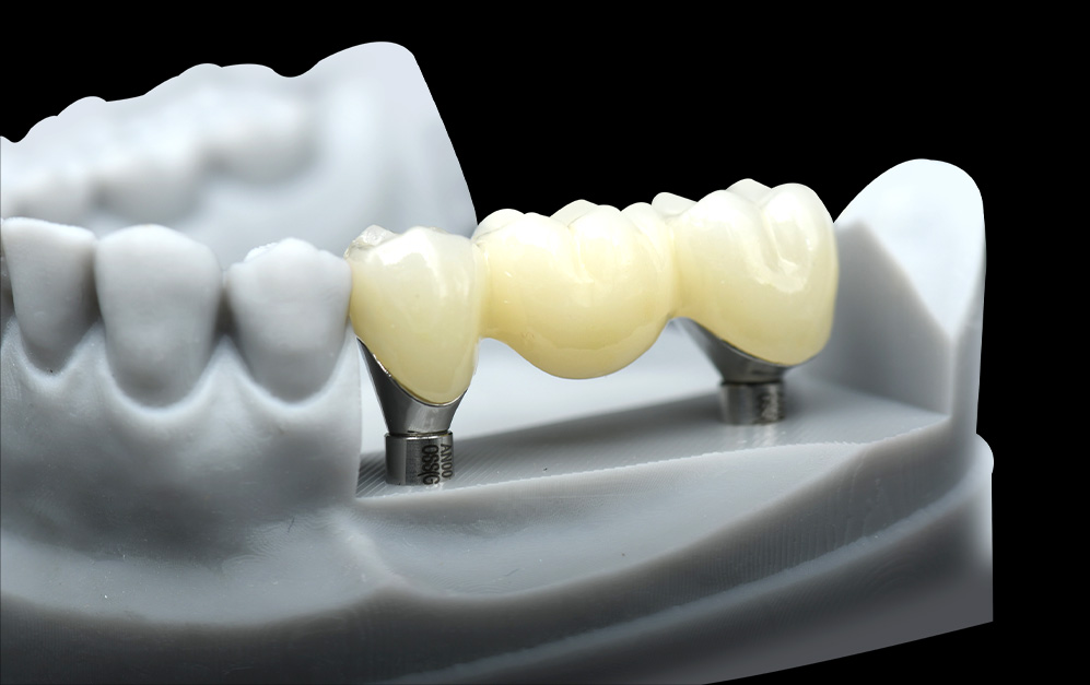 种植基台+氧化锆上部修复