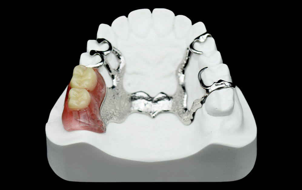 BPD完美支架+排牙