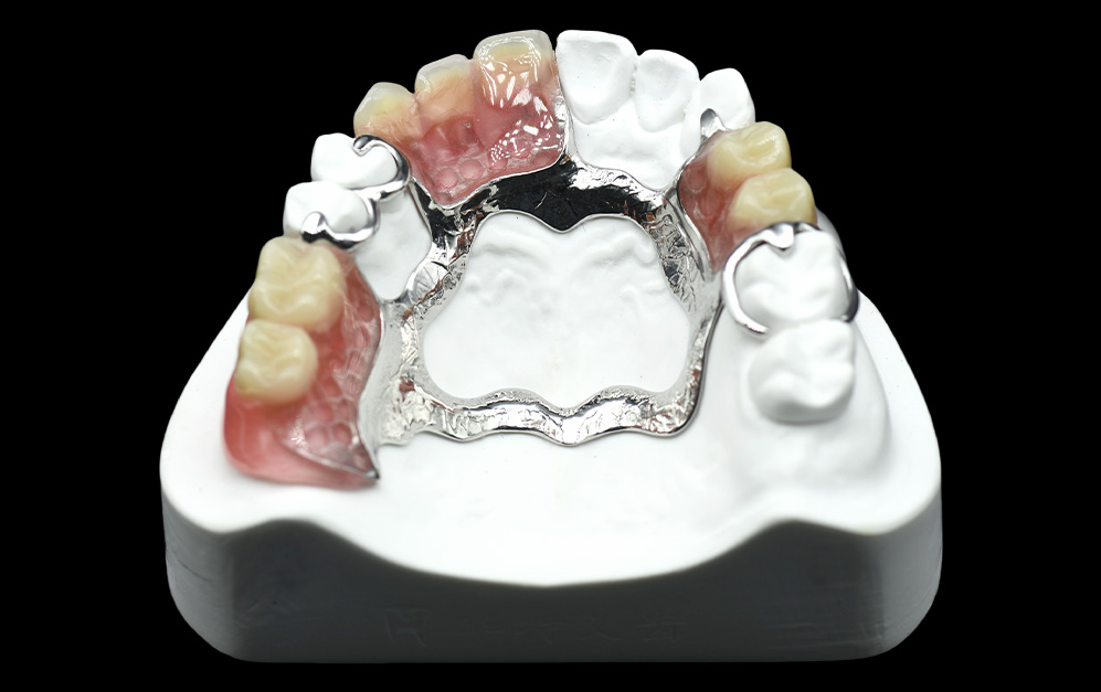 维他灵支架+排牙