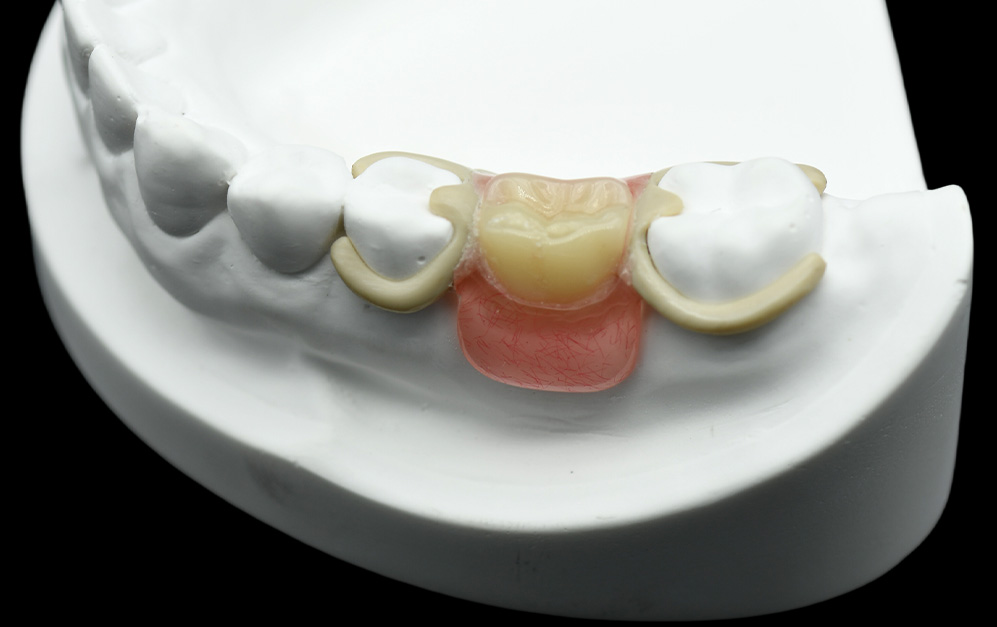 PEEK小支架+排牙