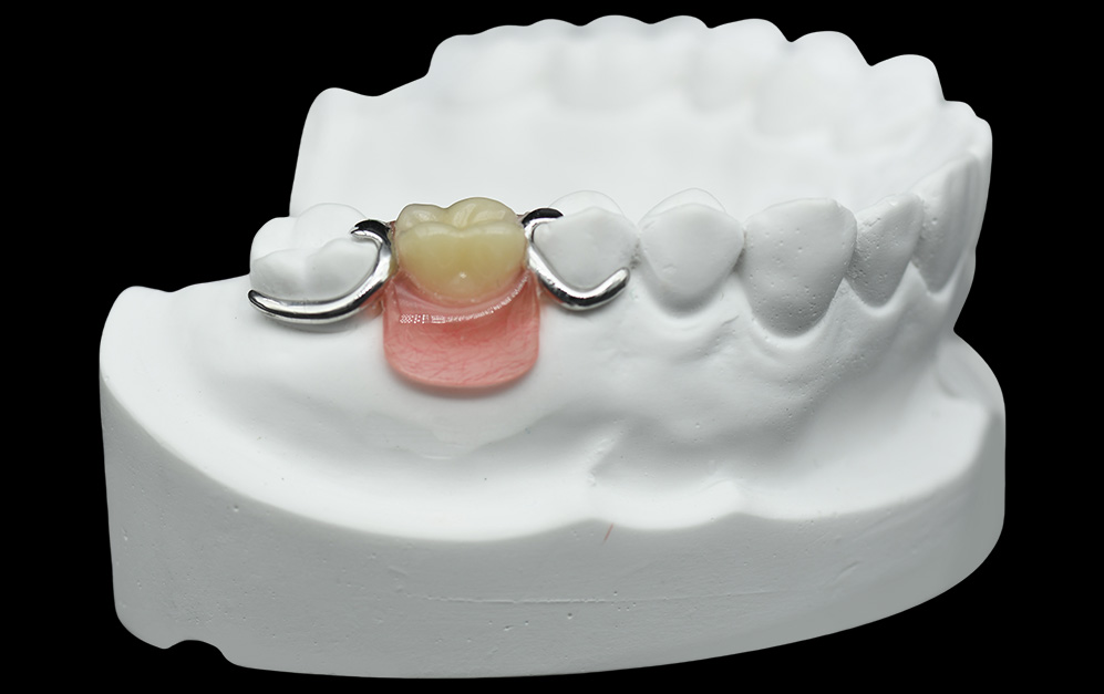 钴铬合金小支架+排牙