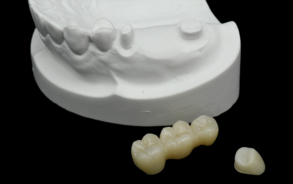 氧化锆套筒冠+氧化锆