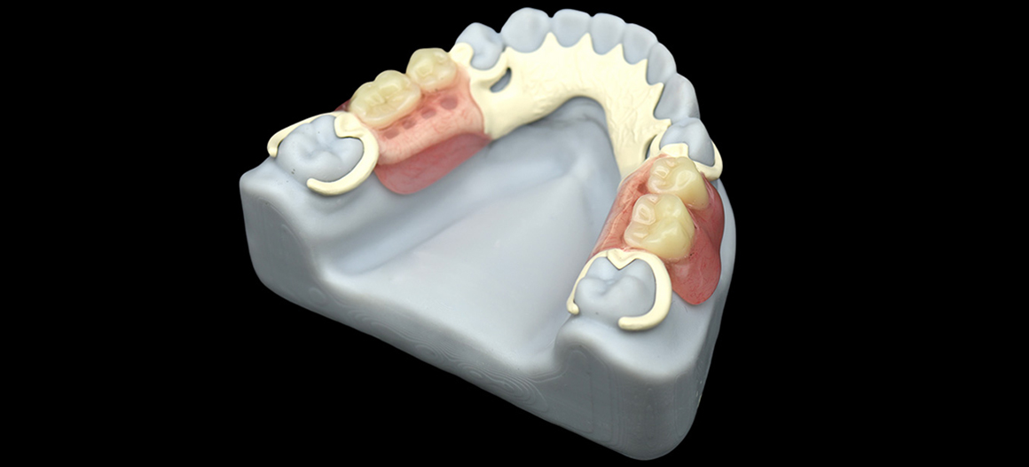 数字化 PEEK支架