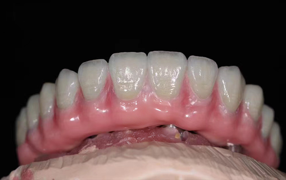 马泷桥钛架+氧化锆上部修复案例展示